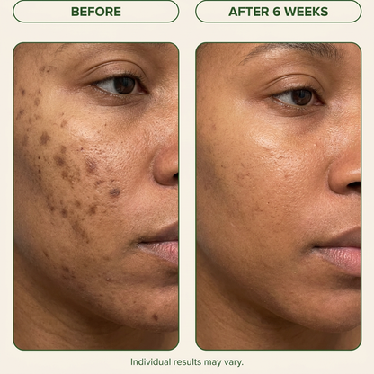 Turmeric Glow Bar (With Kojic Acid)